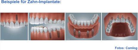 Fotos: Camlog  Beispiele für Zahn-Implantate: