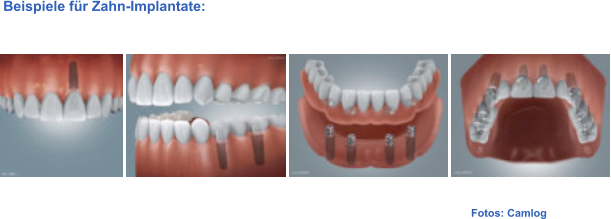 Fotos: Camlog  Beispiele für Zahn-Implantate: