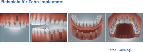 Fotos: Camlog  Beispiele für Zahn-Implantate: